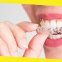 5 Factors To Look Into When Getting Invisalign In Winnipeg