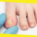 All You Need To Know About An Ingrown Toenail