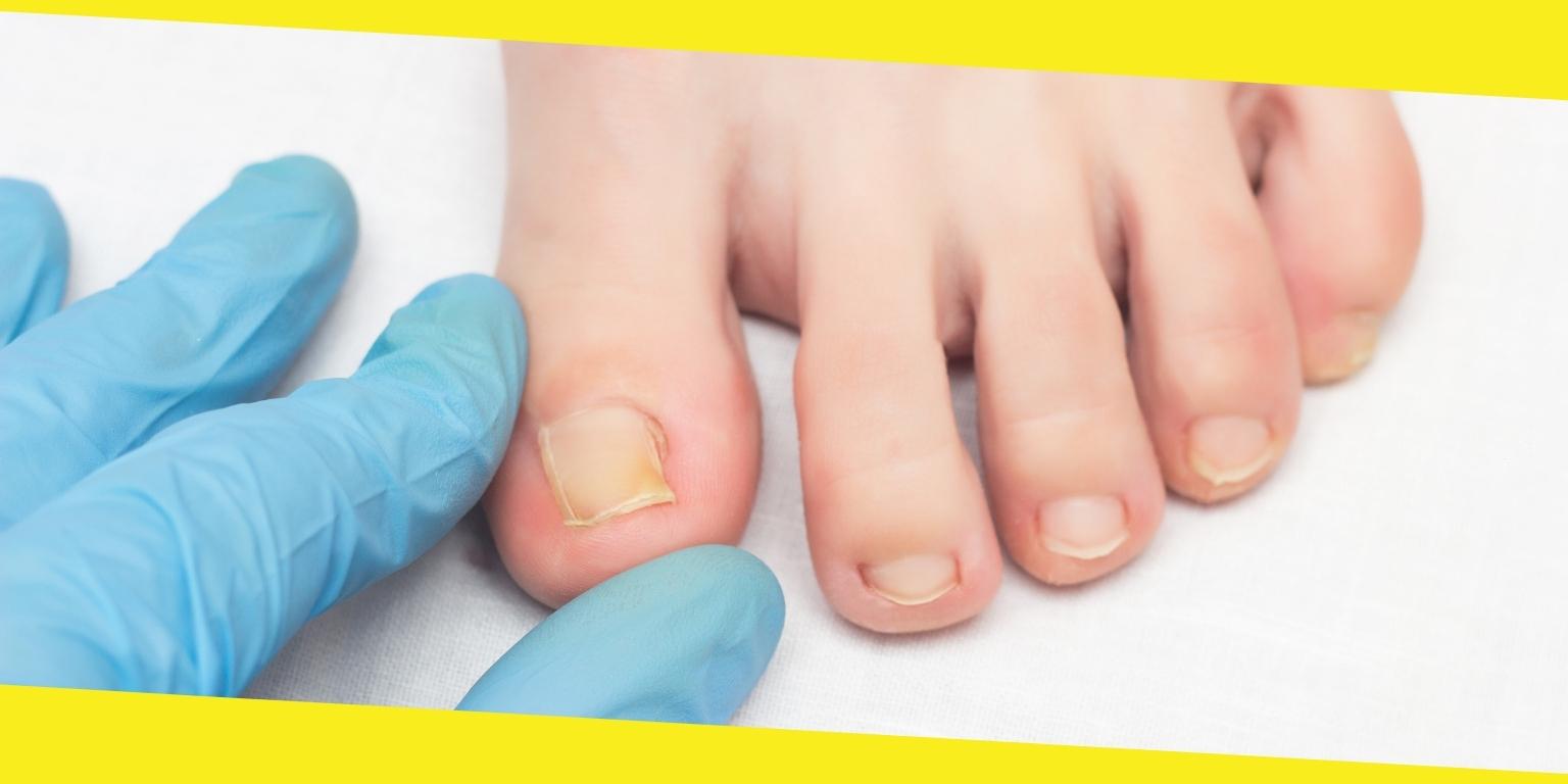 Ingrown Toenail