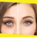 What is Blepharoplasty – What to Expect