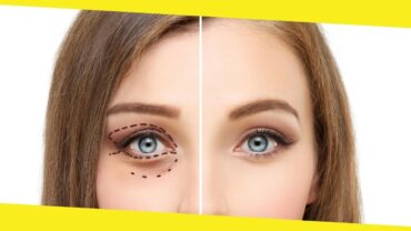 What is Blepharoplasty – What to Expect