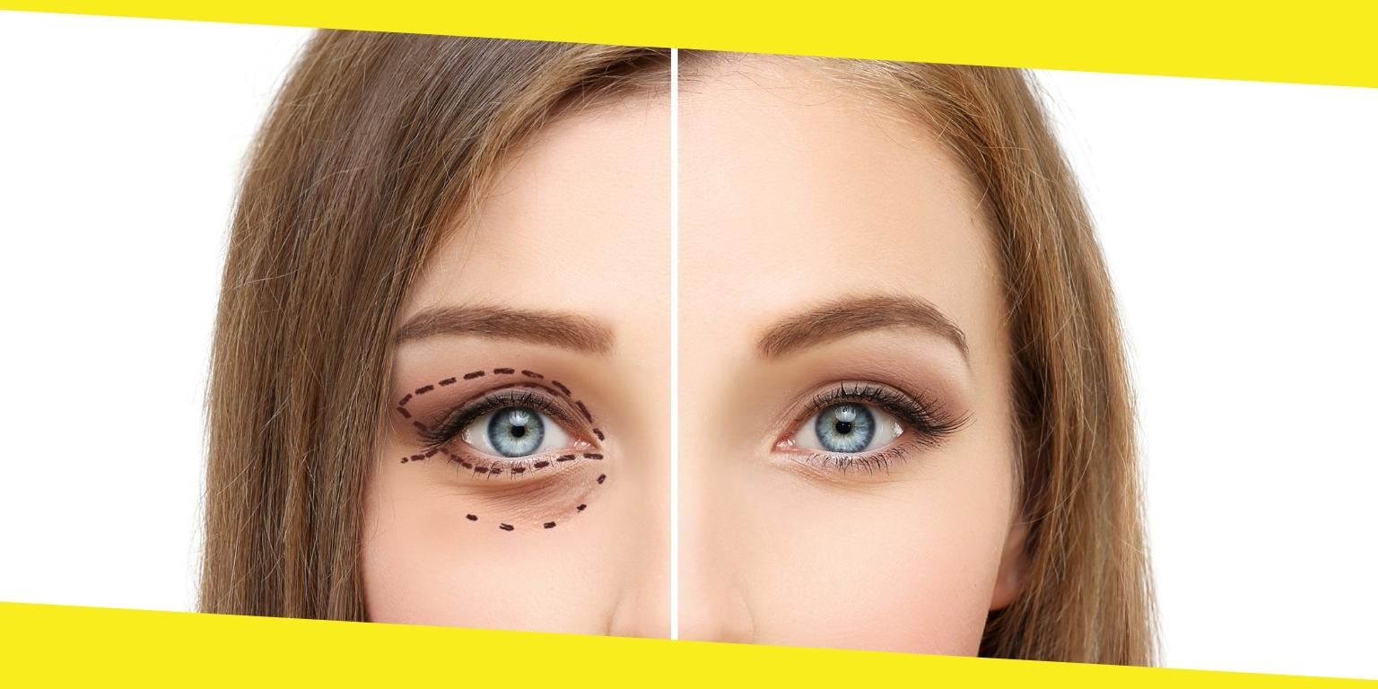 Blepharoplasty