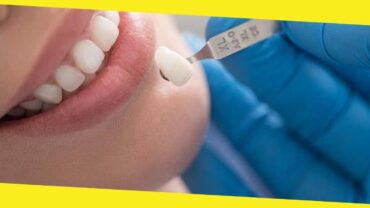 Getting a Perfect Smile with Porcelain Veneers