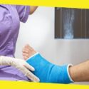 Top Myths About Bone Fractures
