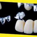 What Makes You a Good Candidate for Dental Bridges?