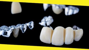 What Makes You a Good Candidate for Dental Bridges?
