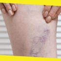 Premier Varicose Veins Care in Illinois