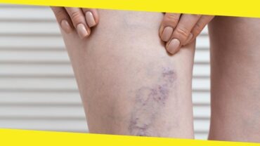 Premier Varicose Veins Care in Illinois