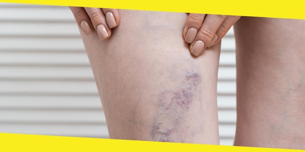 Varicose Veins