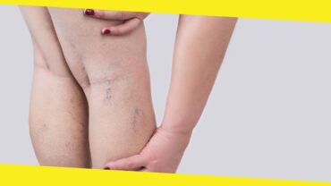 Here are 5 Effective Ways to Handle Varicose Veins