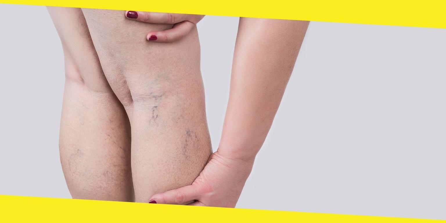 How to Handle Varicose Veins
