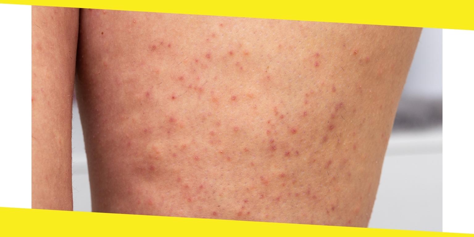 Actinic Keratosis