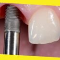 Why Are Dental Implants So Popular?