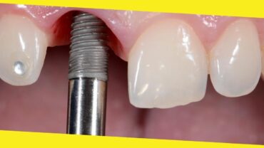 Why Are Dental Implants So Popular?