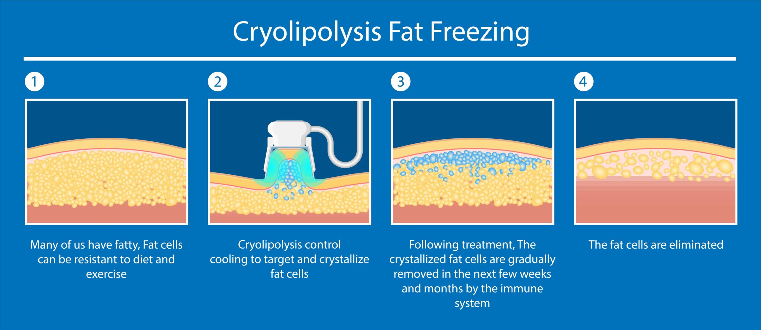 Cryolipolysis