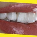 What to Know Before Getting Porcelain Veneers