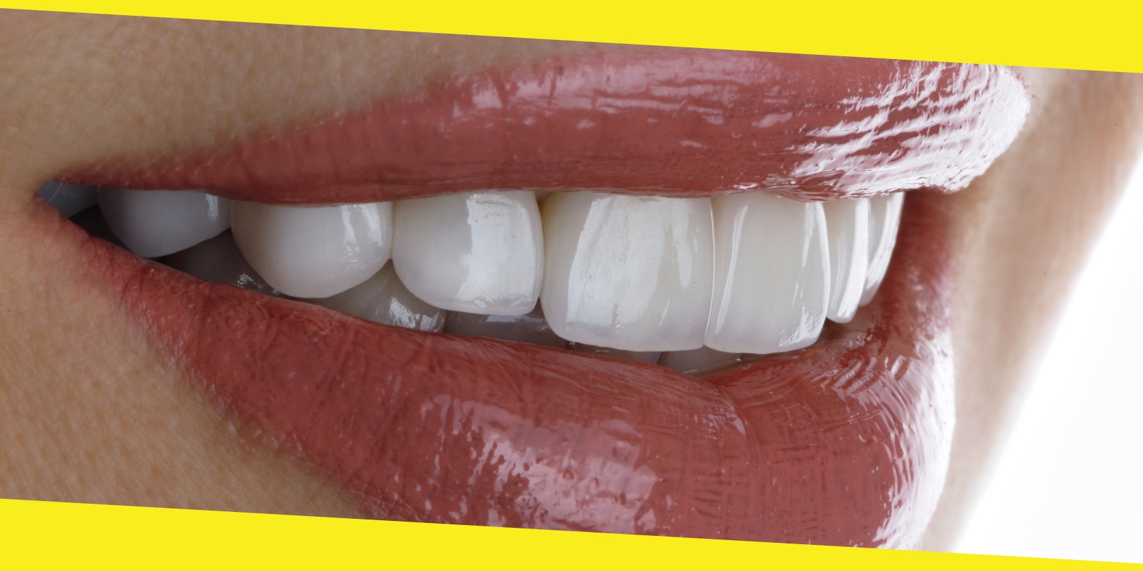 Getting Porcelain Veneers