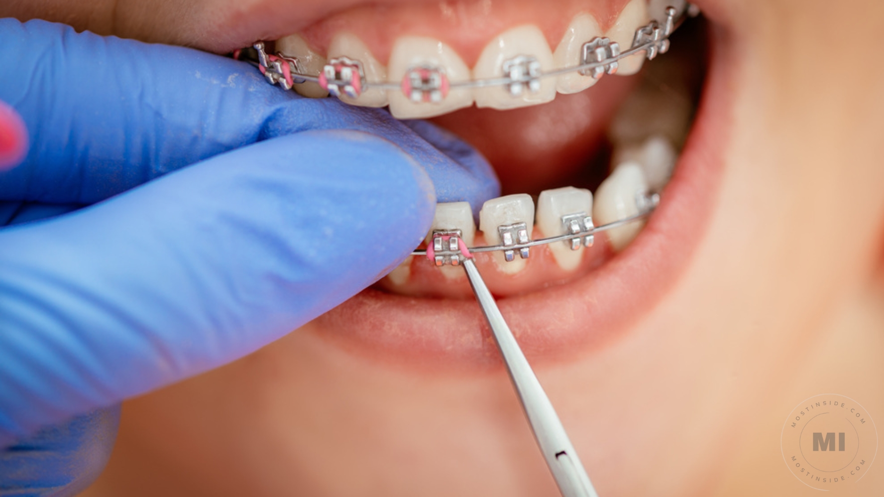 Getting Dental Braces