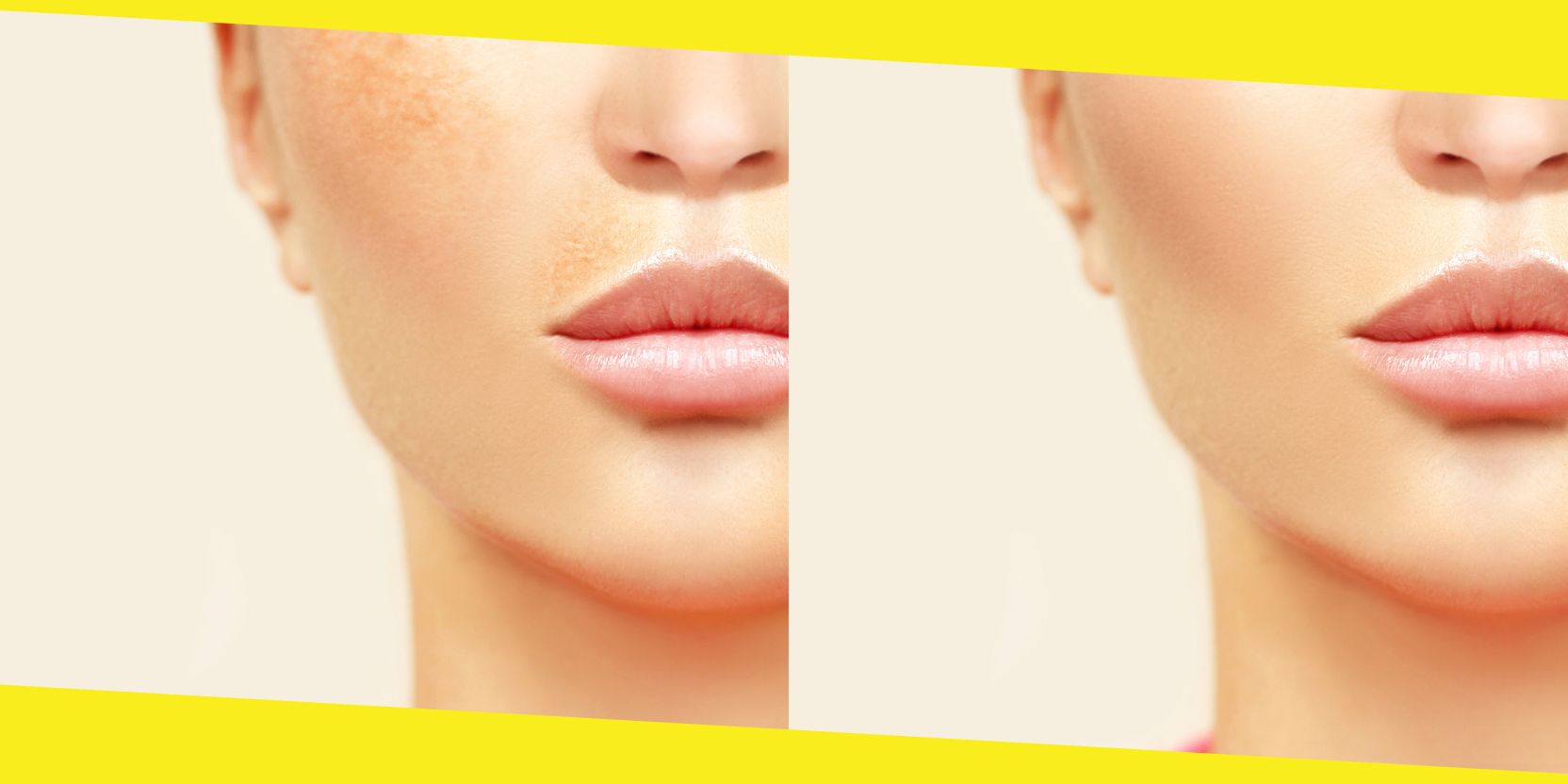Know about Hyperpigmentation