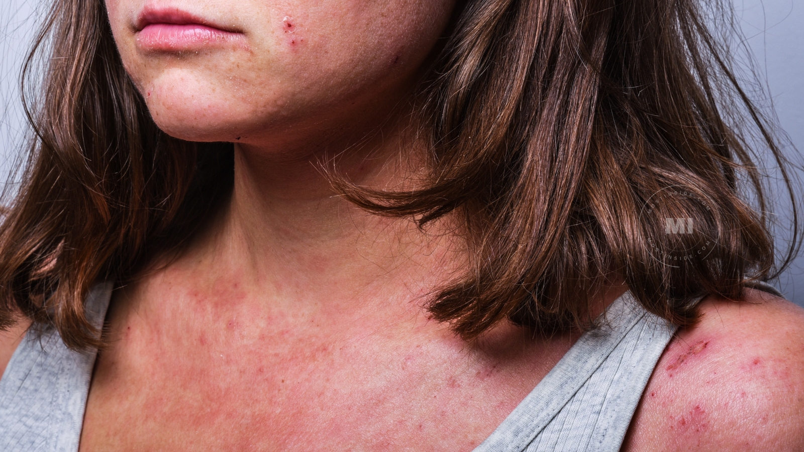 Skin Discoloration When To See A Doctor