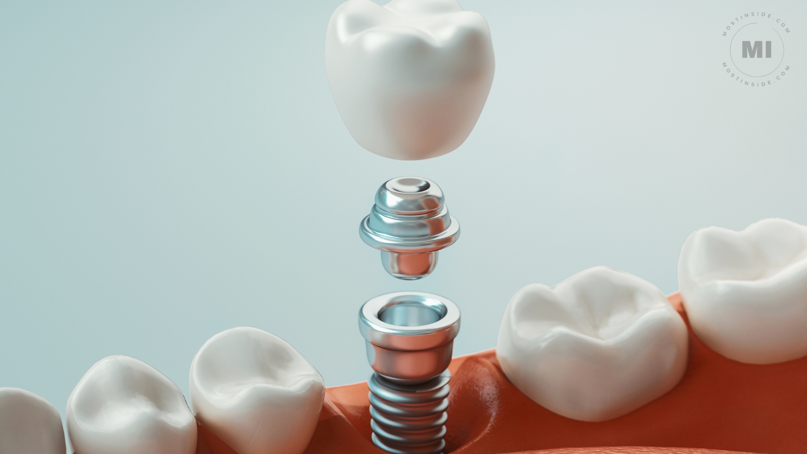 Dental Implants