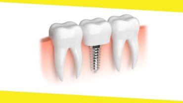 All-On-4 Dental Implants Procedure From Start To Finish