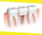 All-On-4 Dental Implants Procedure From Start To Finish