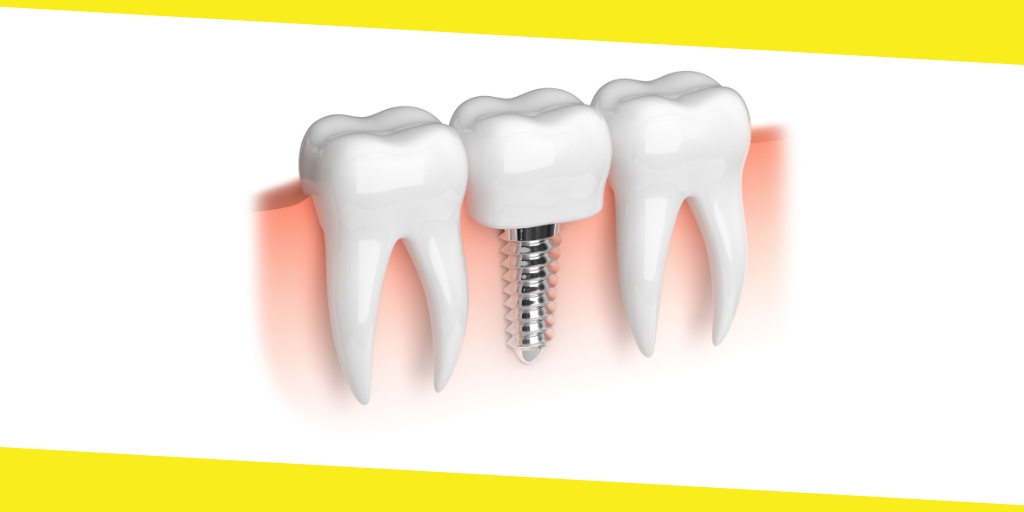 Dental Implants Procedure 