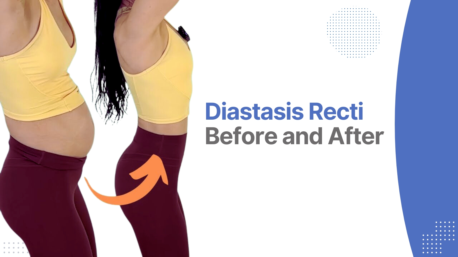 diastasis recti before and after