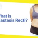 All You Need to Know About Diastasis Recti Repair