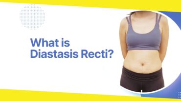 All You Need to Know About Diastasis Recti Repair