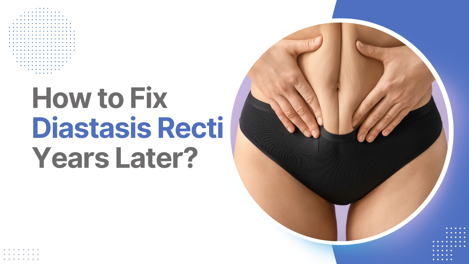 how to fix diastasis recti years later