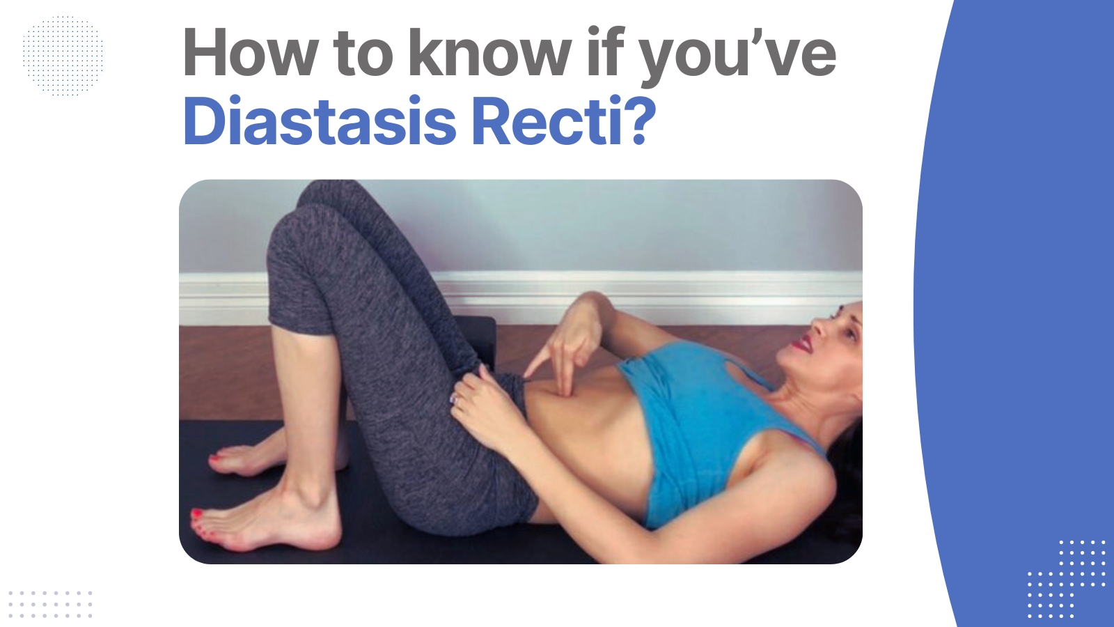 diastasis recti