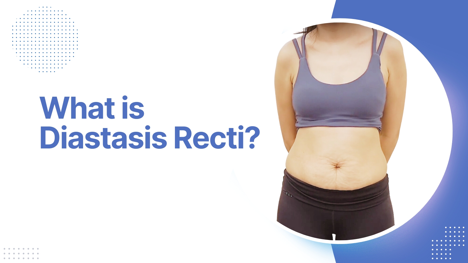 what is diastasis recti