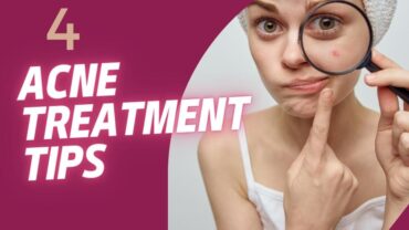 4 Acne Treatment Tips That Actually Work!