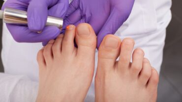 Know How to Prevent Foot and Toenail Fungus