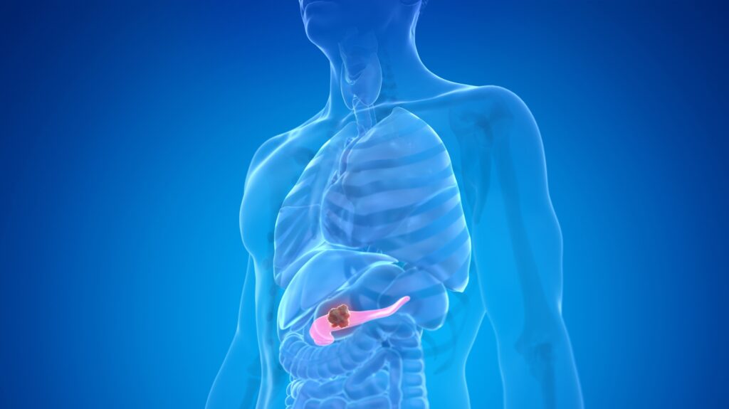 Pancreatic Cancer Treatment