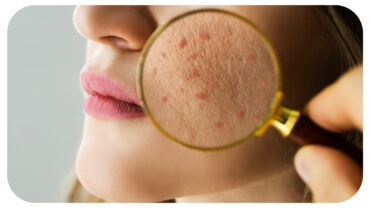 Demystifying Acne: What’s Really Causing Those Breakouts?