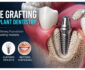 The Role Of Bone Grafting In Successful Implant Dentistry