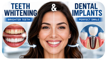 Why Teeth Whitening Often Complements Dental Implant Treatment Plans