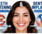 Why Teeth Whitening Often Complements Dental Implant Treatment Plans